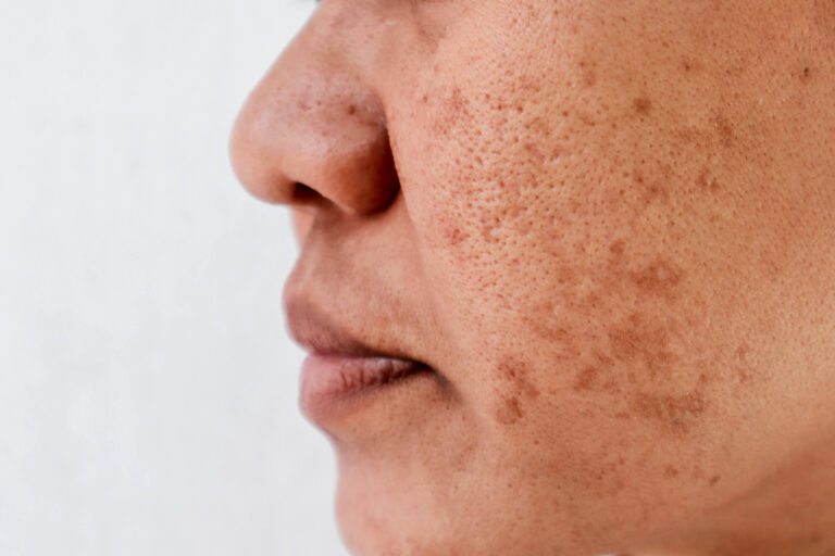 Warts and Skin Tags