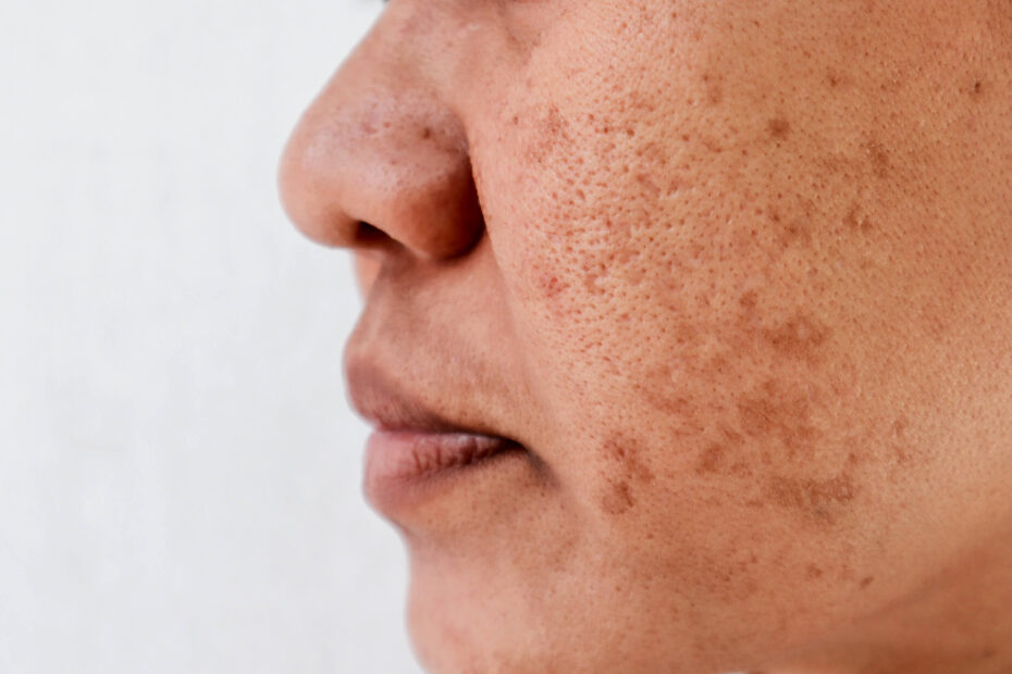 Warts and Skin Tags