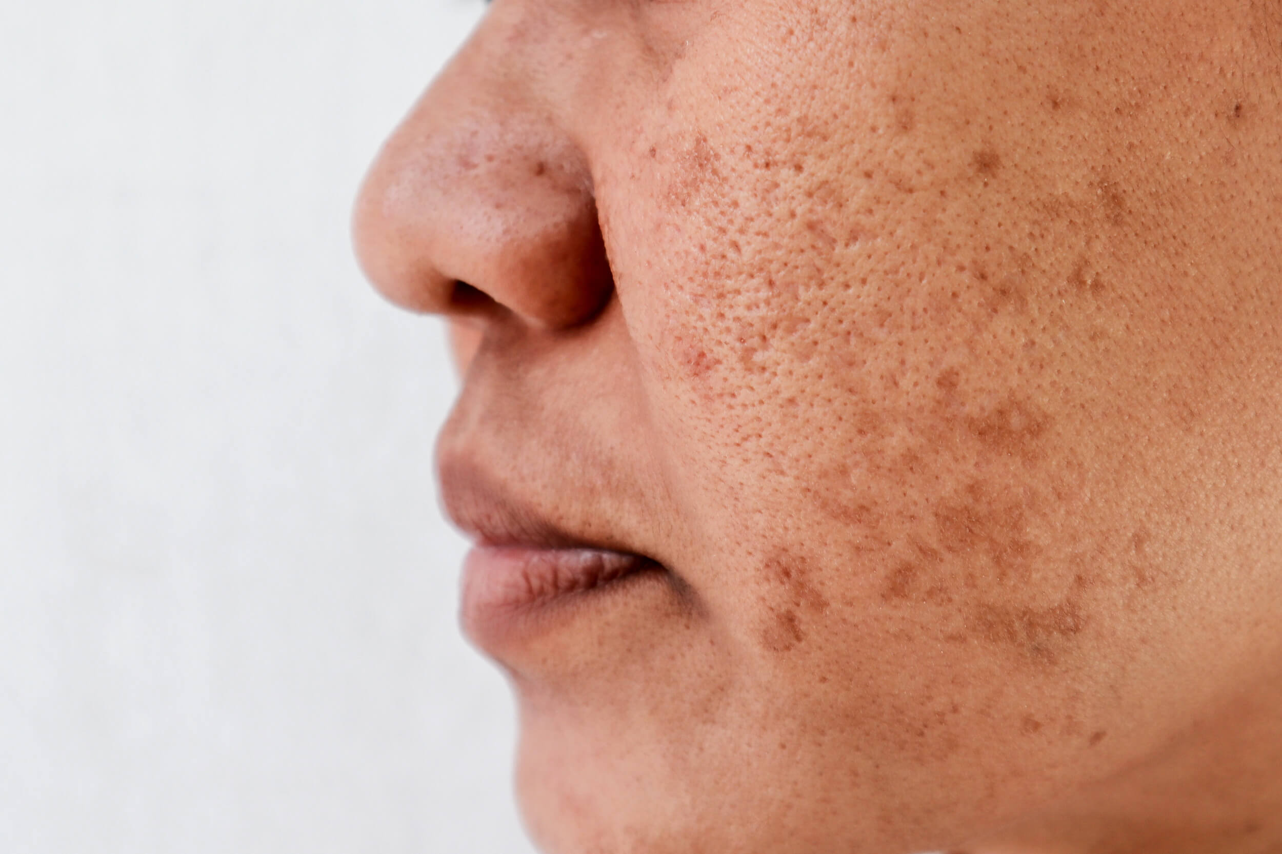 Warts and Skin Tags