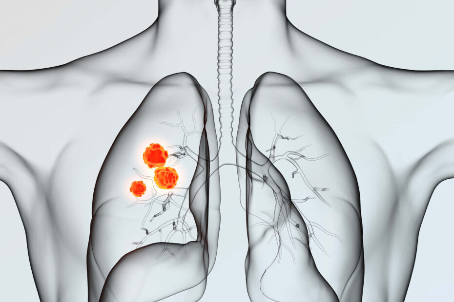 Lung Cancer Risk