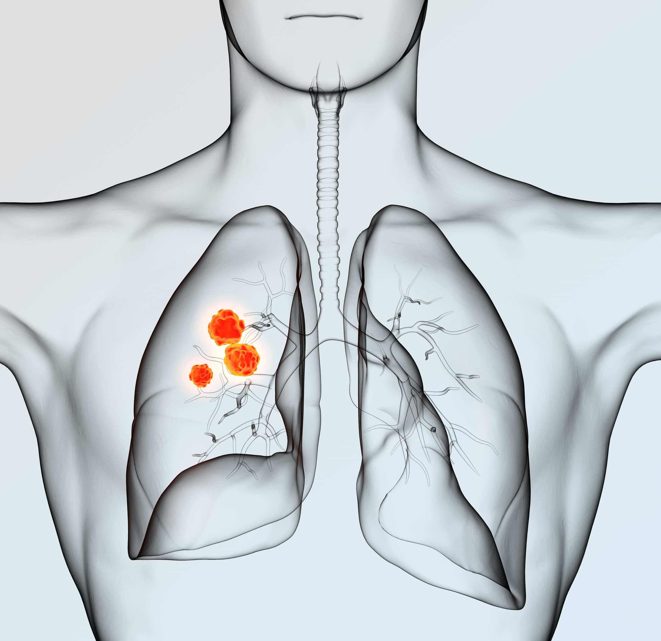 Lung Cancer Risk
