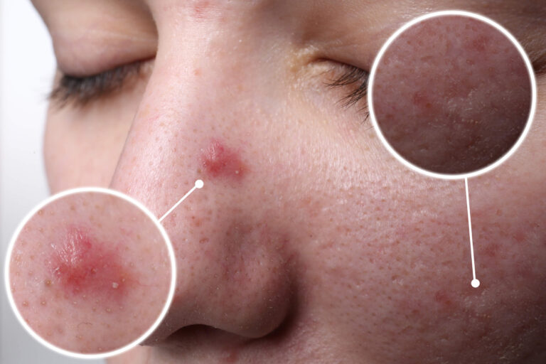 What Your Acne Is Telling You