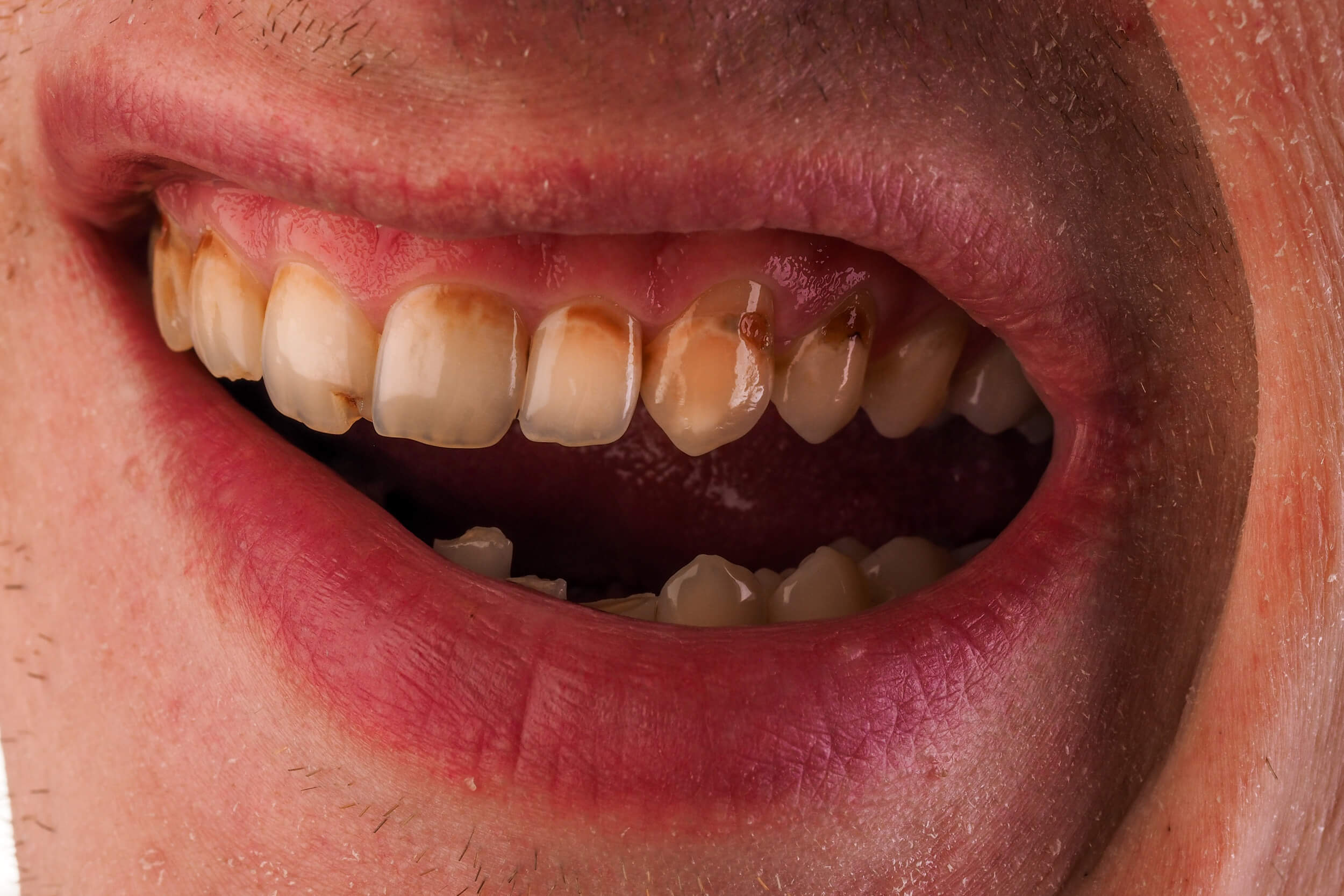 Teeth Care Basics