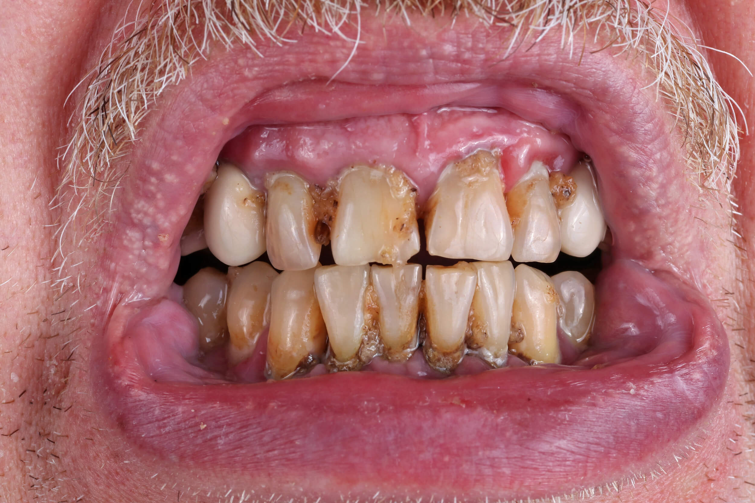 Why Oral Care Matters
