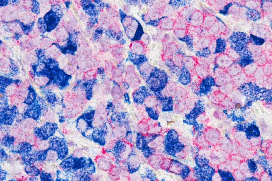 Healing with Breast Cancer